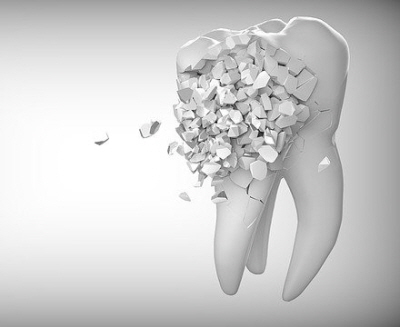 치아 법랑질이 조금 검게 보이더라도 치아 표면에 구멍이 나지 않았다면 무조건 치료할 필요가 없다는 게 일부 양심적인 치과의사들의 주장이다.