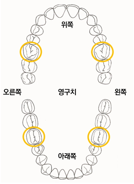 제1대구치(첫번째 큰 영구치 어금니, 총 4개)의 위치, 노란색 동그라미. 서울대치과 제공.